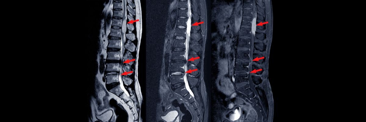 Lumbar Canal Stenosis: What You Need to Know