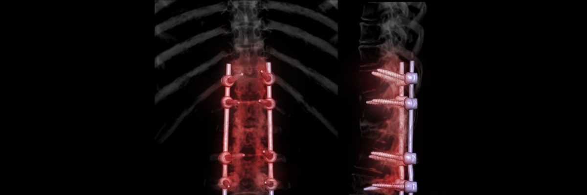 Lumbar Stabilization Surgery – A Simple Guide for Lower Back Stability and Pain Relief
